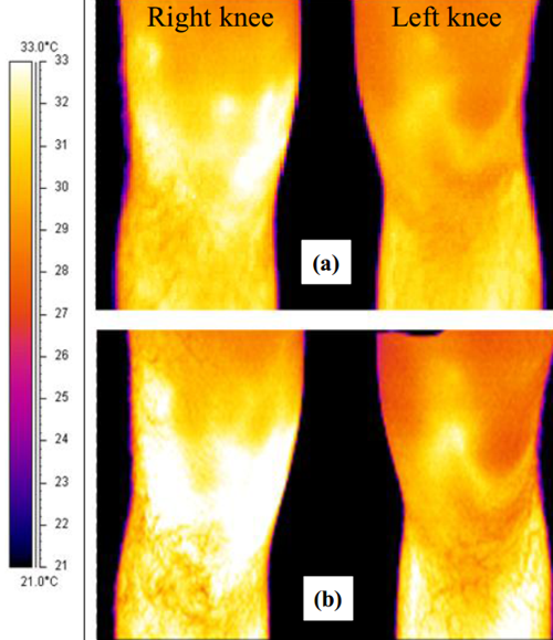 右膝OA運動員比賽前后左右膝蓋的紅外熱成像